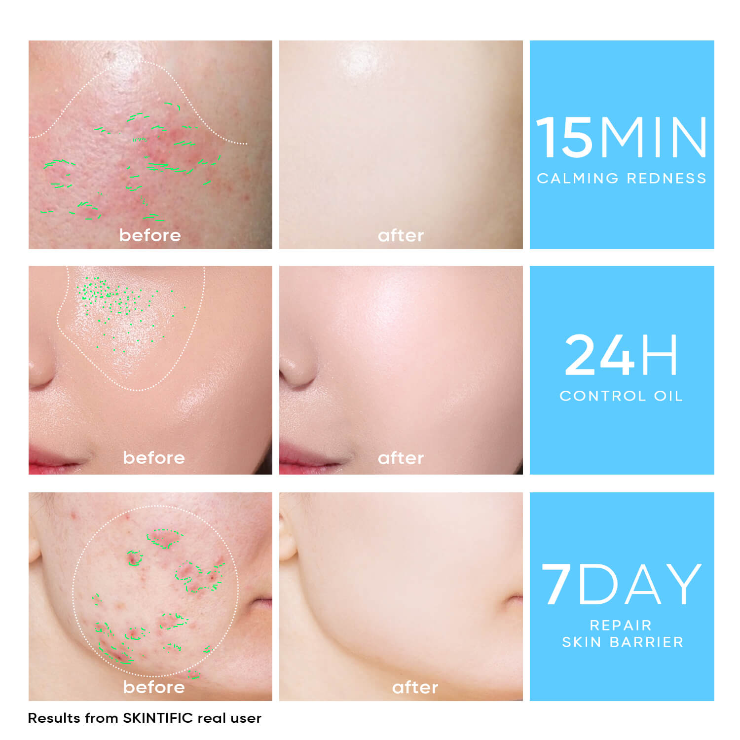 SKINTIFIC Oil control moisturizer before and after results for redness and skin barrier repair
