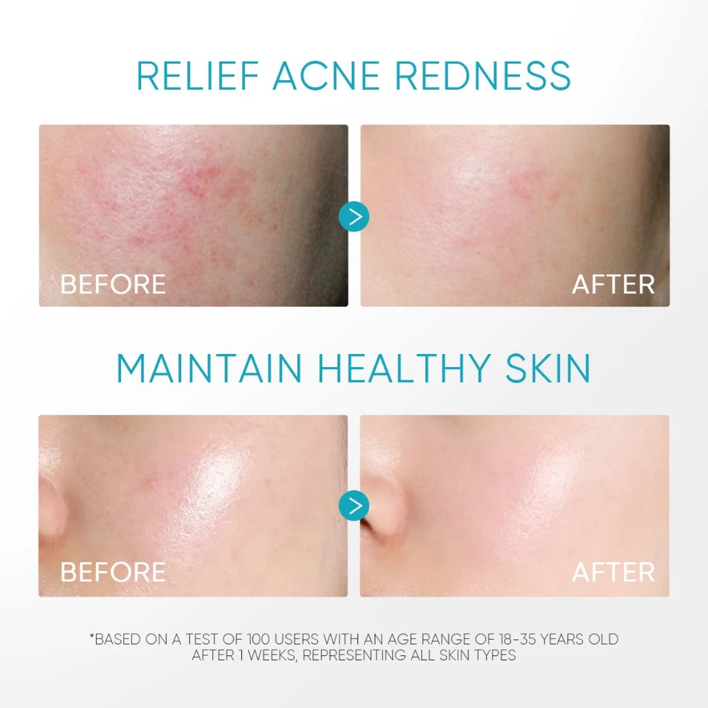 5% Panthenol Acne Calming Water Gel